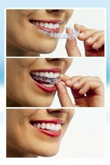 L'ORTHODONTIE INVISIBLE