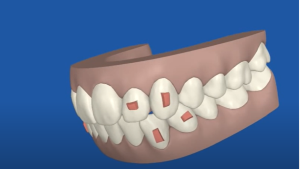 Invisalign clincheck orthodontie sherbrooke