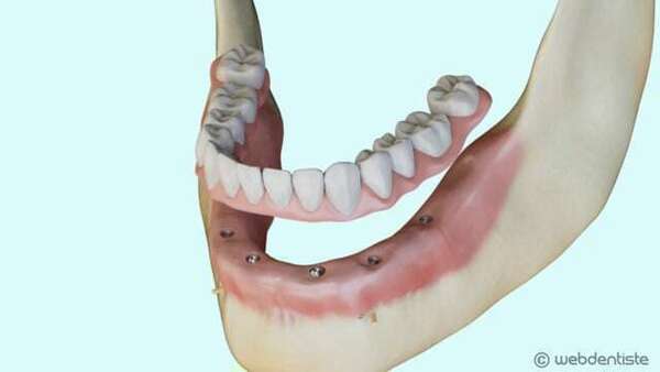 Prothèse complète vissée sur implant