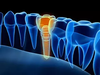 Implant