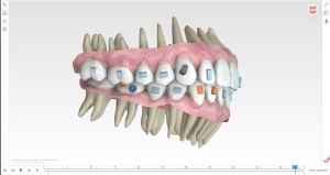 Cas Orthodontie invisible visualisation 3D