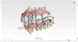Cas Orthodontie invisible Visualisation 3D