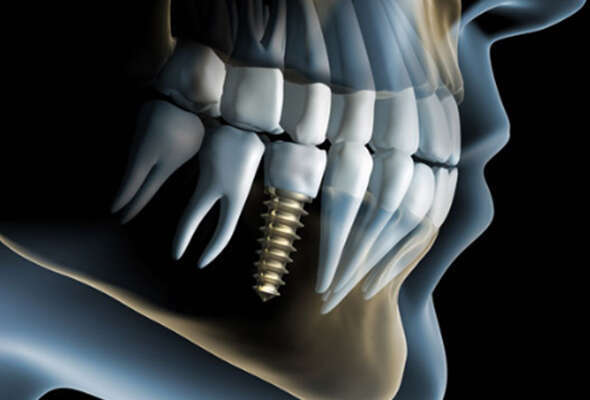 QU'EST-CE QU'UN IMPLANT DENTAIRE ? INDICATIONS ET CONTRE-INDICATIONS