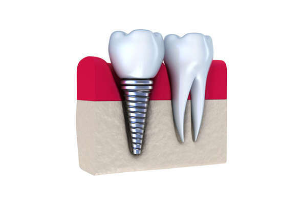 POSE D'IMPLANTS DENTAIRES