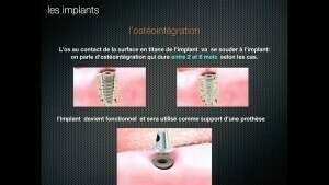 Qu'est ce qu'un implant dentaire ?