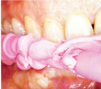 Eléments de mise en oeuvre clinique du 3M Bite Registration