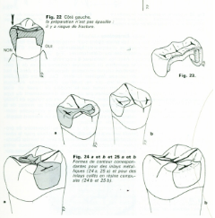 L'INLAY COLLÉ EN RÉSINE COMPOSITE