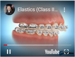 Correction avec élastique classe 2