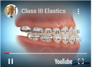 Correction avec élastique classe 3