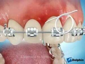 Nettoyage des brackets avec du fil dentaire
