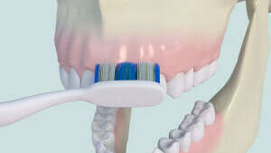 Brossette interdentaire et parodontite