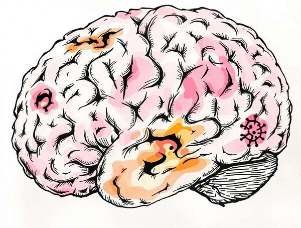 Comment certaines infections peuvent affecter la mémoire ?