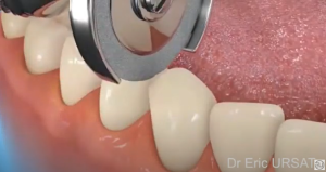Recontournement des dents (Stripping dentaire)