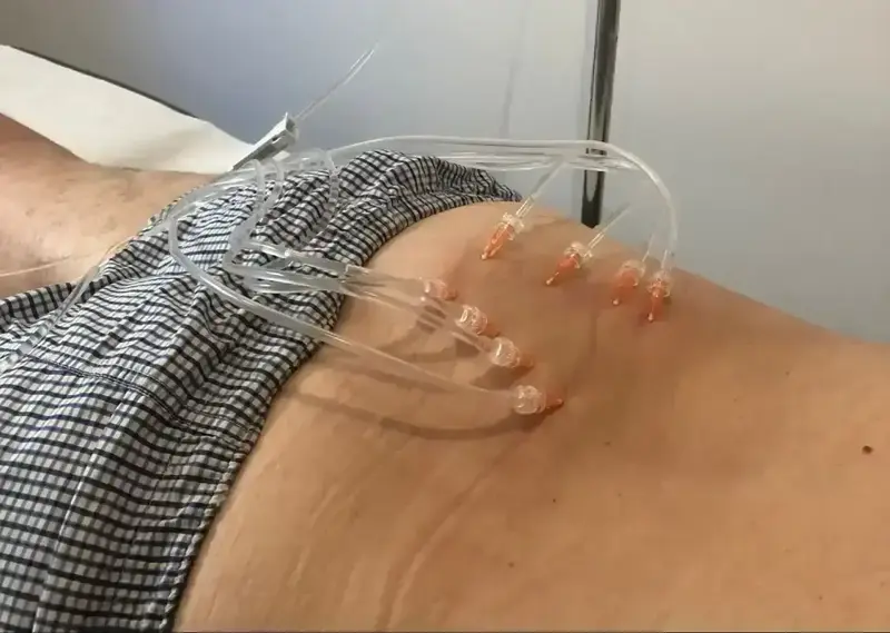 Hydrotomie percutanée 