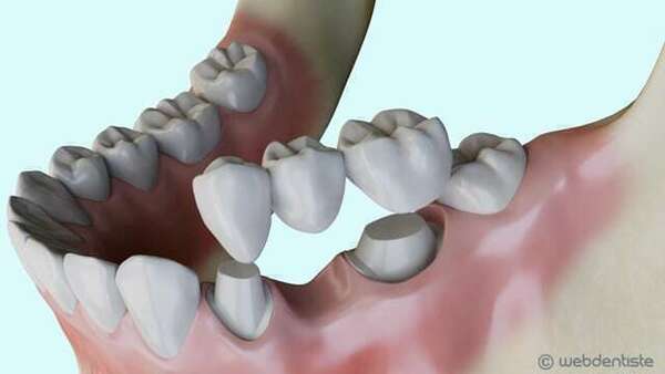 Remplacement d’une dent absente par un bridge