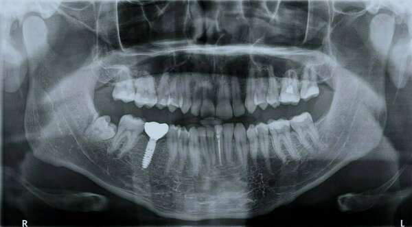 Scanner vs Radio panoramique