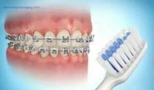 Brossage des dents avec brackets