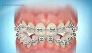 Port d'élastiques verticaux