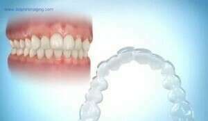 Alignement par gouttières