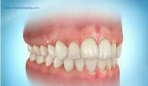 Brackets autoligaturants