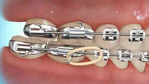 Port d'élastiques de cl II