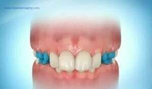 Multi-attache partiel