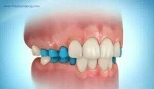 Plaque d'expansion mandibulaire