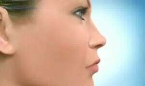 Extraction des 4 2ème prémolaires