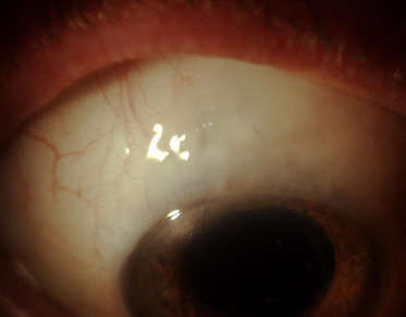 Dogme vs Médecine fondée sur les preuves: méthodes d'administration et concentration de mitomycine C en chirurgie du glaucome