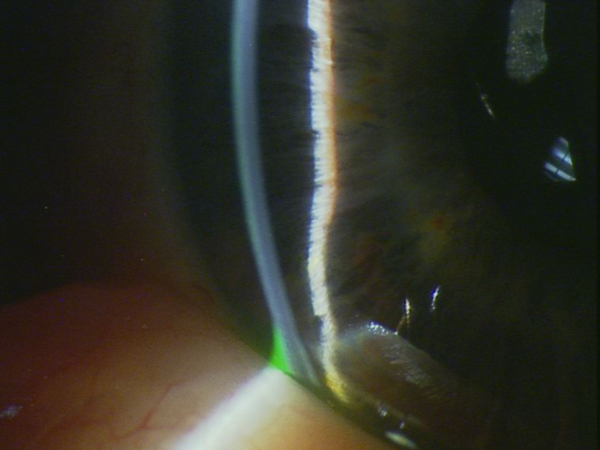 Prise en charge des glaucomes à angles étroits en 2020