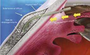 Chirurgie Mini-Invasive du Glaucome - Implant XEN