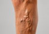 Massage thérapeutique ciblant les jambes pour soulager varices