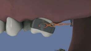 Implant orthodontique : redressement d'une molaire