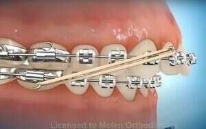 Correction avec élastique classe 2.