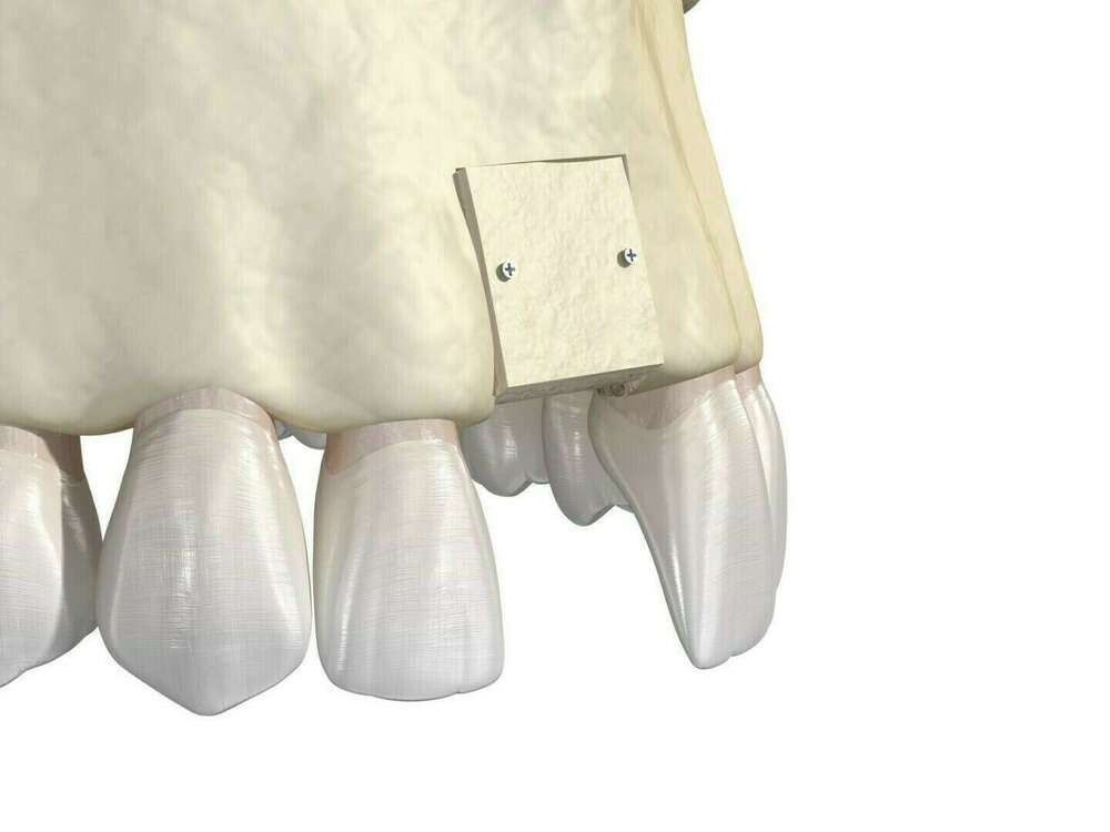 La greffe osseuse d'apposition ou greffe en onlay