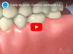 Carie du pont