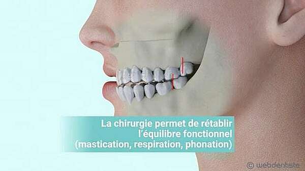 La chirurgie orthognatique – rétrognathie maxillaire