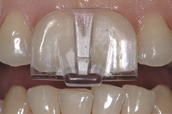 Gouttière pour réduire les tensions sur les mâchoires.