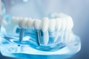 Prothèse dentaire sur implants, modèle de démonstration