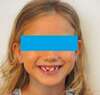 Photographie de face d'une jeune patiente en denture mixte, prise lors du bilan