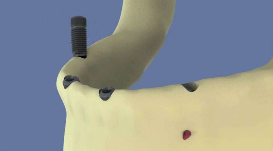 Mandibule : all-on-4