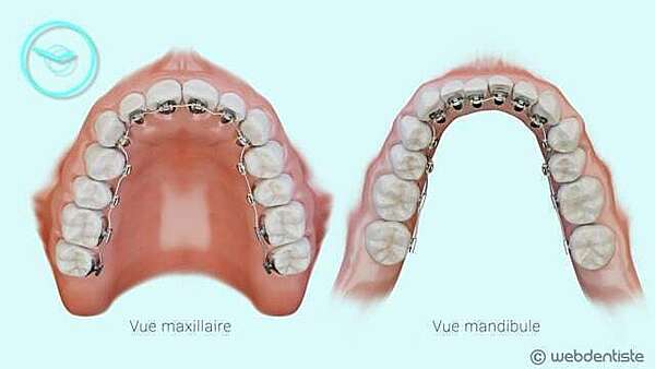 Appareil multi-attache lingual