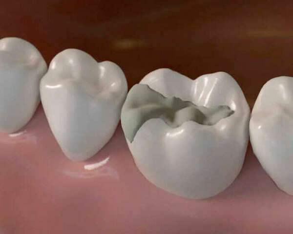 INLAY ET ONLAY, UNE TECHNIQUE CONSERVATRICE