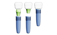 QUELS SONT LES AVANTAGES DES IMPLANTS DENTAIRES ?