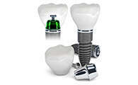 DANS QUELS CAS PEUT-ON UTILISER DES IMPLANTS DENTAIRES ?