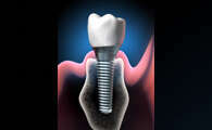 QU'EST-CE QU'UN IMPLANT DENTAIRE ?