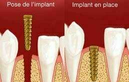 POSE D'IMPLANTS - DENTISTE - NICE