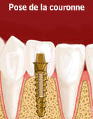 PROTHESE DENTAIRE SUR IMPLANT - DENTISTE - NICE