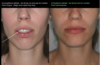Correction incompétence labiale avant et après