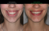 Correction sourire gingival avant et après